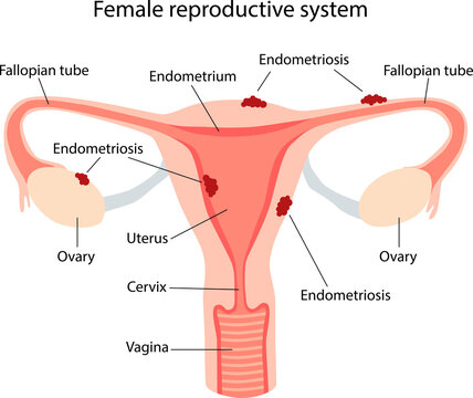 Endometriosis, schematic illustration of the female reproductive system diseases