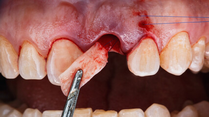 soft tissue suturing after dental implantation to restore gum volume in the area of the central tooth