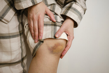 Knee injury close up. Checking for an injury on a leg with a hematoma. Close-up of a girl rubbing...