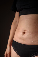 Woman natural belly with stretch marks and scars. Body positive