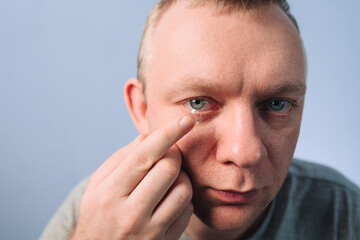 Man inserting clear transparent contact lens in eye. Correction of myopia eyesight