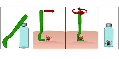 Illustration of special tweezers for removing ticks. Instructions for removing a tick with special tweezers. Tick ​​bite. Placing the tick in a container. Vector illustration - obrazy, fototapety, plakaty