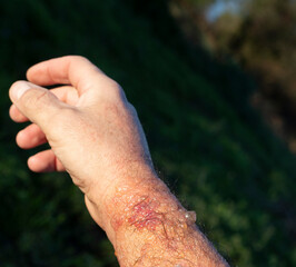 blistered forearm badly affected by phytophotodermatitis.