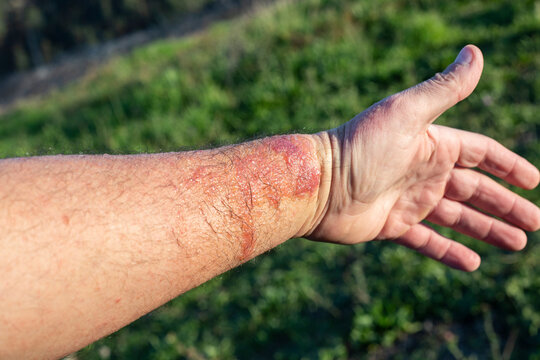 arm badly affected by phytophotodermatitis. copy space