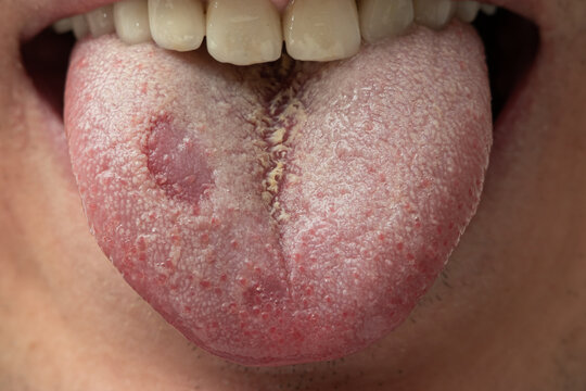 Candida yeast covere tongue of a opened mouth Caucasian male. Close up shot, unrecognizable face