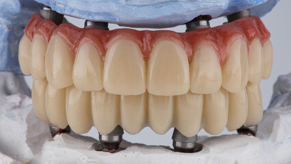 excellent dental prostheses of the upper and lower jaws on beams and models