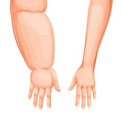 Edema swollen hand or arm. Lymphedema, eodema disease vector. Cartoon human body forearms and hands, swollen and healthy arms, fingers, wrists and elbows comparison - obrazy, fototapety, plakaty