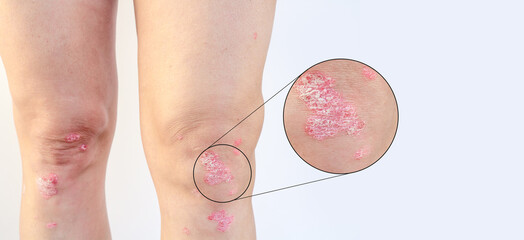 An enlarged, macro-detailed circle is visible above the knee affected by psoriasis, a closer...