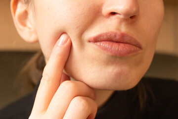 Young woman points her finger at her lips infected herpes virus. Indignation look. Diseases of the...