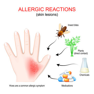 allergic reaction and skin lesions. Human hand with skin rash