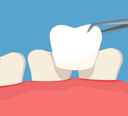 Tooth restoration. Installing a new veneer on a discolored tooth. Vector cartoon illustration