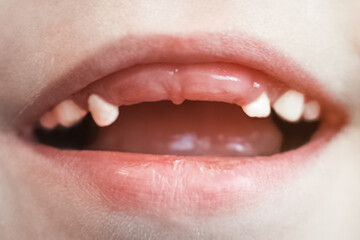 Photo of a child's mouth missing his two front teeth. Close-up