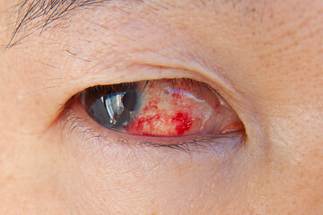 Closeup Asian man eye with subconjunctival hemorrhage