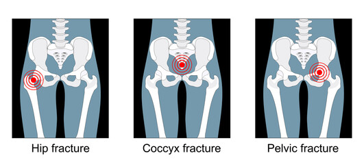 hip fracture, break of the sacrum or pelvis, pain in the coccyx - obrazy, fototapety, plakaty