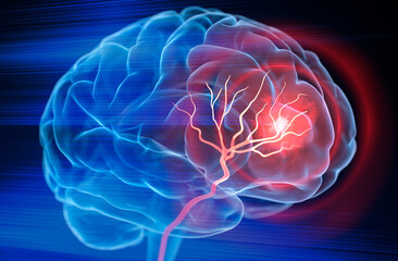 X- Ray illustration of brain stroke  - 3d Illustration