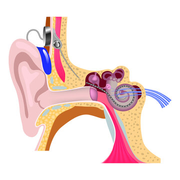 cochlear implantation system. Hearing back with inner ear surgery. Electron array. Vector illustration