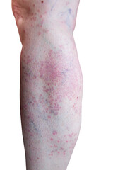 Detail of a generalized Granuloma annulare, a rare skin disease, on a leg of a female patient