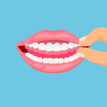 Mouth Guard. Teeth With Transparent Braces. Alignment Of Teeth By Aligners. Orthodontic Dentistry Concept. Dental Care. Vector Illustration Isolated On Blue Background.