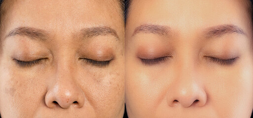 Image before and after spot melasma pigmentation facial treatment on asian woman face. skincare and health problem concept