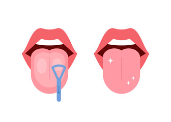 Fototapeta Clean tongue throat cleaner scraper in mouth. Before and after tongue cleaning. Halitosis prevention. Vector illustration obraz