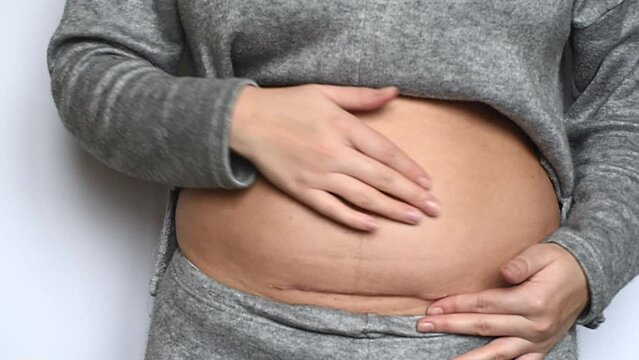 Women belly fat, postpartum belly front view video. Woman shows a seam on the abdomen after caesarean section surgery