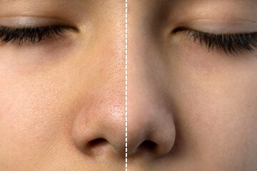Retouched image compared before and after treatment blackhead acne on teenager boy's nose. Beauty...