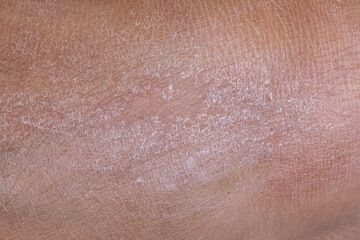 Damaged dry skin condition surface