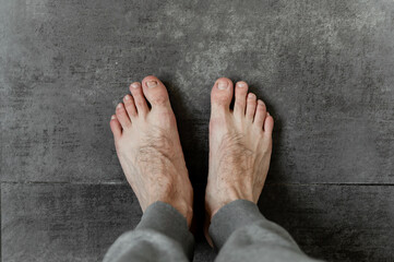Fototapeta premium male feet with fungus and different dermatological problems close-up on a dark background. hairy feet. toenail problem. foot skin problem