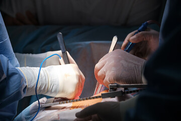 Closeup of professional doctor hands operating a patient during open heart surgery in surgical room. Healthcare and medical intervention concept