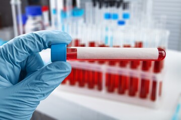 Biochemist hold test tubes with blood sample for test.