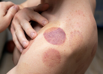 Hematoma on man shoulders after session of vacuum cans. blood marks after taking Chinese cupping...
