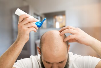 Methods of hair transplantation. Human alopecia or hair loss problem on adult senior or mature man.