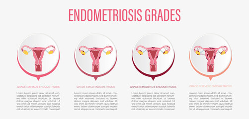 Vector illustration of degrees of endometriosis.