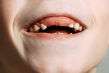Photo of a child's mouth missing his two front teeth New teeth can't grow for a long time New teeth...
