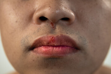 Cracked lips of man in winter season. Close up shot. This man skin is asian style.