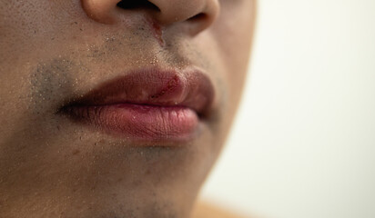 Cracked lips of man in winter season. Close up shot. This man skin is asian style.