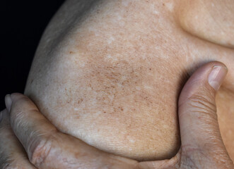 Age spots on body. They are brown, gray, or black spots and also called liver spots, senile lentigo, solar lentigines, or sun spots.