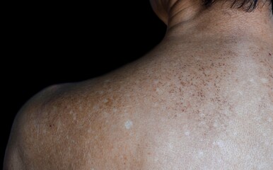 Age spots and white patches on upper back. They are brown, gray, or black spots and also called liver spots, senile lentigo, solar lentigines, or sun spots. - obrazy, fototapety, plakaty