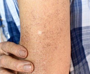 Age spots and white patches on the arm. They are brown, gray, or black spots and also called liver...
