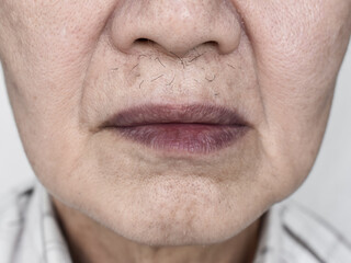 Cyanotic lips or central cyanosis at Southeast Asian man