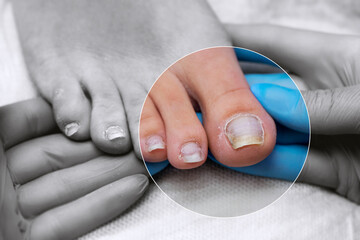 Onycholysis of toenails in men. Therapeutic male pedicure in the salon. The doctor examines a male...