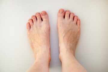 Feet with swollen veins