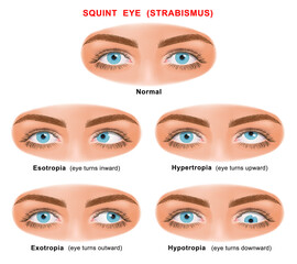 Strabismus or crossed eyes types - esotropia, exotropia, hypertropia, hypotropia.  normal human eyes and eyes with problem. For advertisement and medical publications. illustration