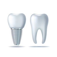 Vector 3d realistic white Tooth and dental Implant. Denture icon closeup isolated on white