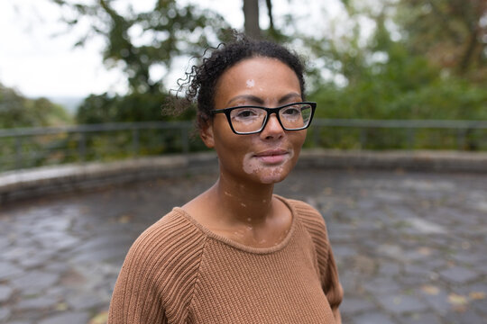 portrait of a girl with vitiligo
