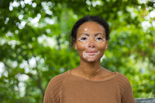 girl with vitiligo 
