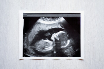 ultrasound image of baby inside mothers belly laying on white table. Newborn child concept.