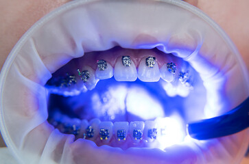 Close-up of the mouth. Installation of metal braces.