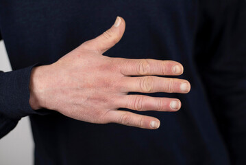Obraz premium A man holds a hand with dry cracked skin in front of him, which often happens to him due to cold frosty weather. The concept of care for dry cracked skin of hands in men