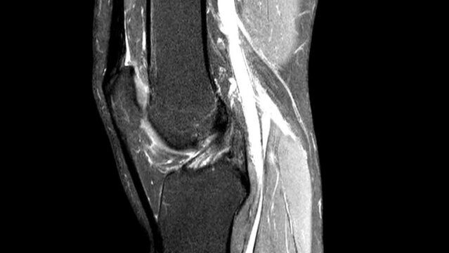 MRI knee joint. Magnetic resonance imaging of right knee. Diagnosis sport trauma and damage of ligaments.